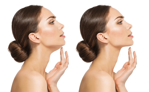 Double Chin Treatment